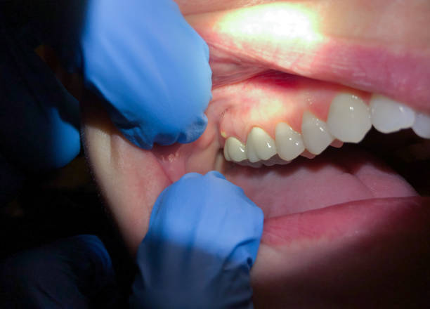 Best Emergency Tooth Extraction in Brinckerhoff, NY